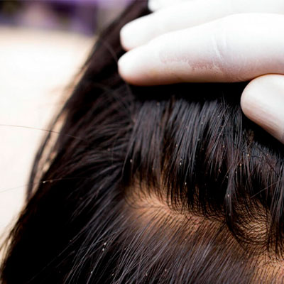 Профессиональное уничтожение вшей в Волгограде