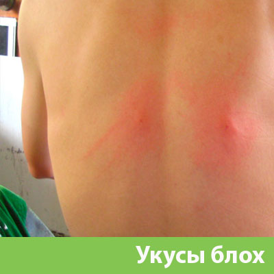 Укусы блох в Волгограде