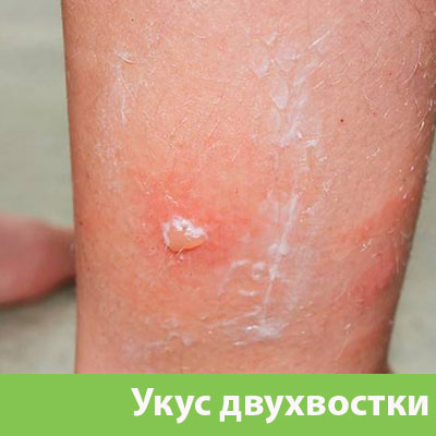 Укус двухвостки в Волгограде