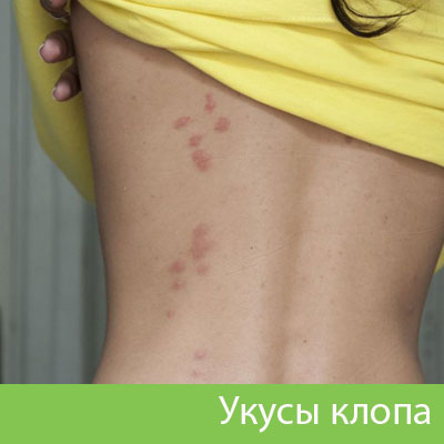 Профессиональное уничтожение клопов в Волгограде